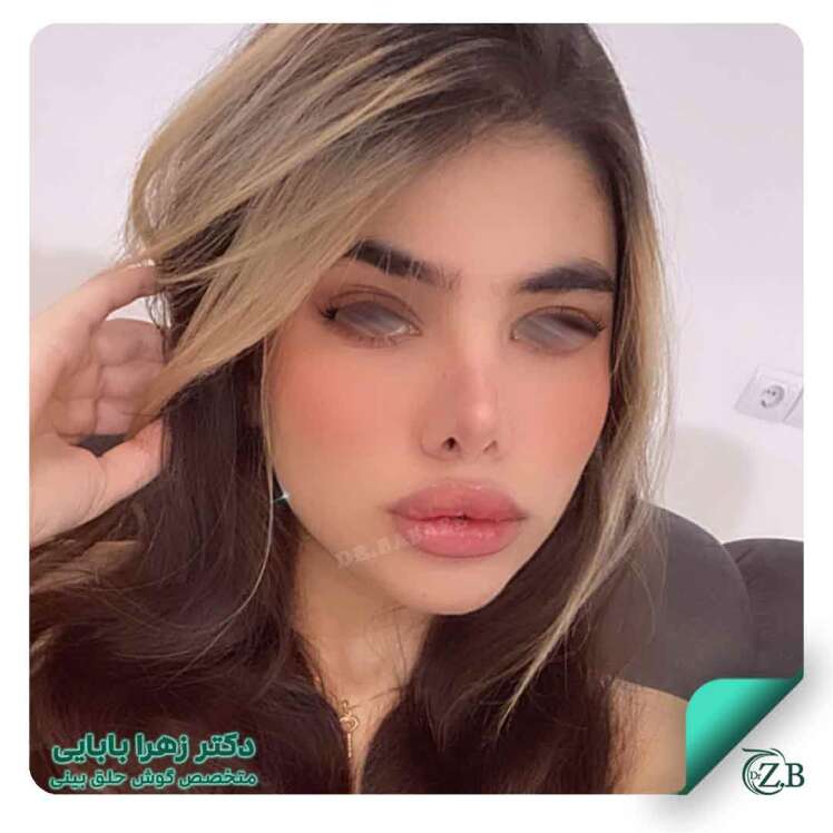 آگمنتیشن لب و مزایای آن